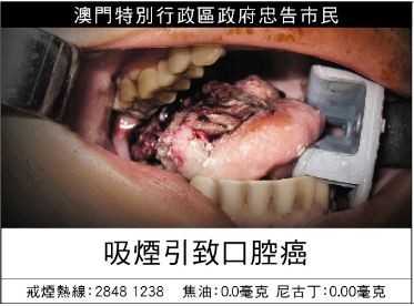 Macau 2013 Health Effects mouth - oral cancer, gross (Chinese)